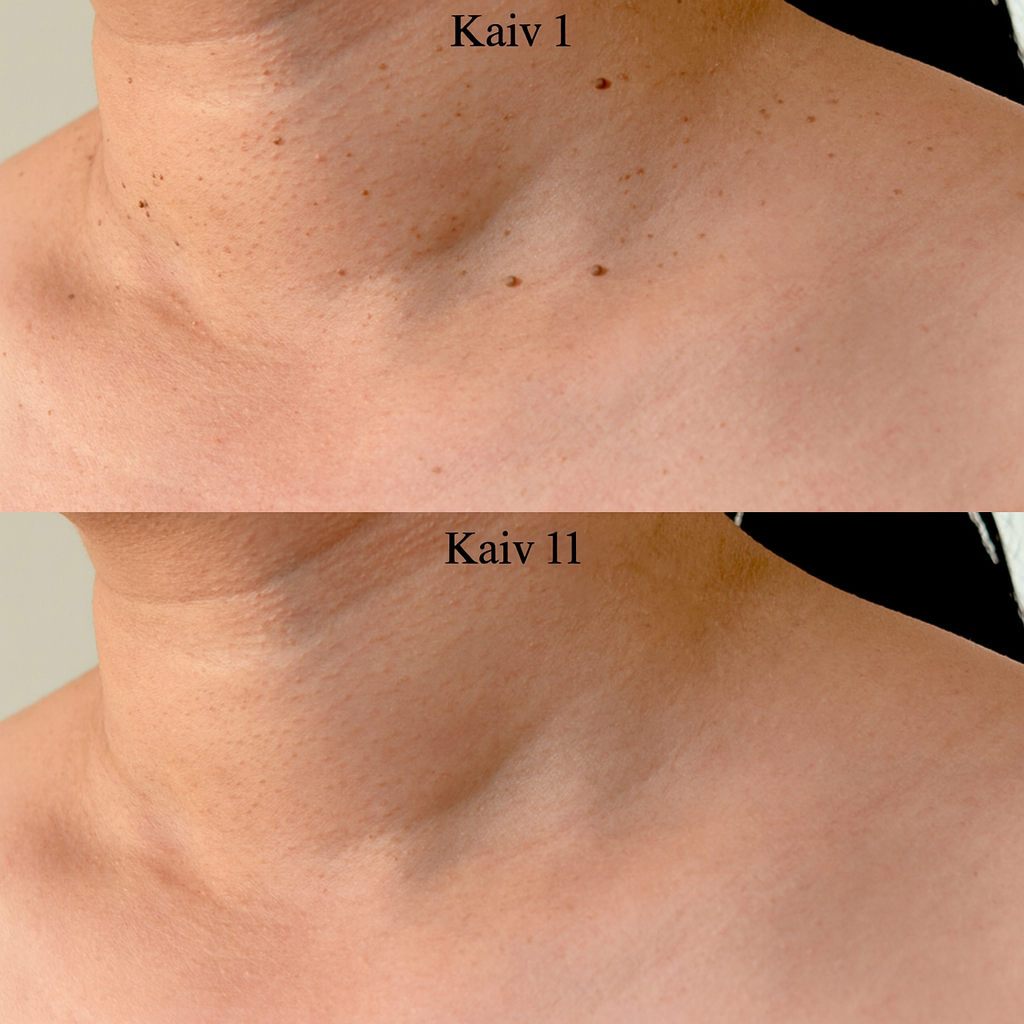 DermaClear Kit™ – Ei enää ihomuutoksia tai syyliä