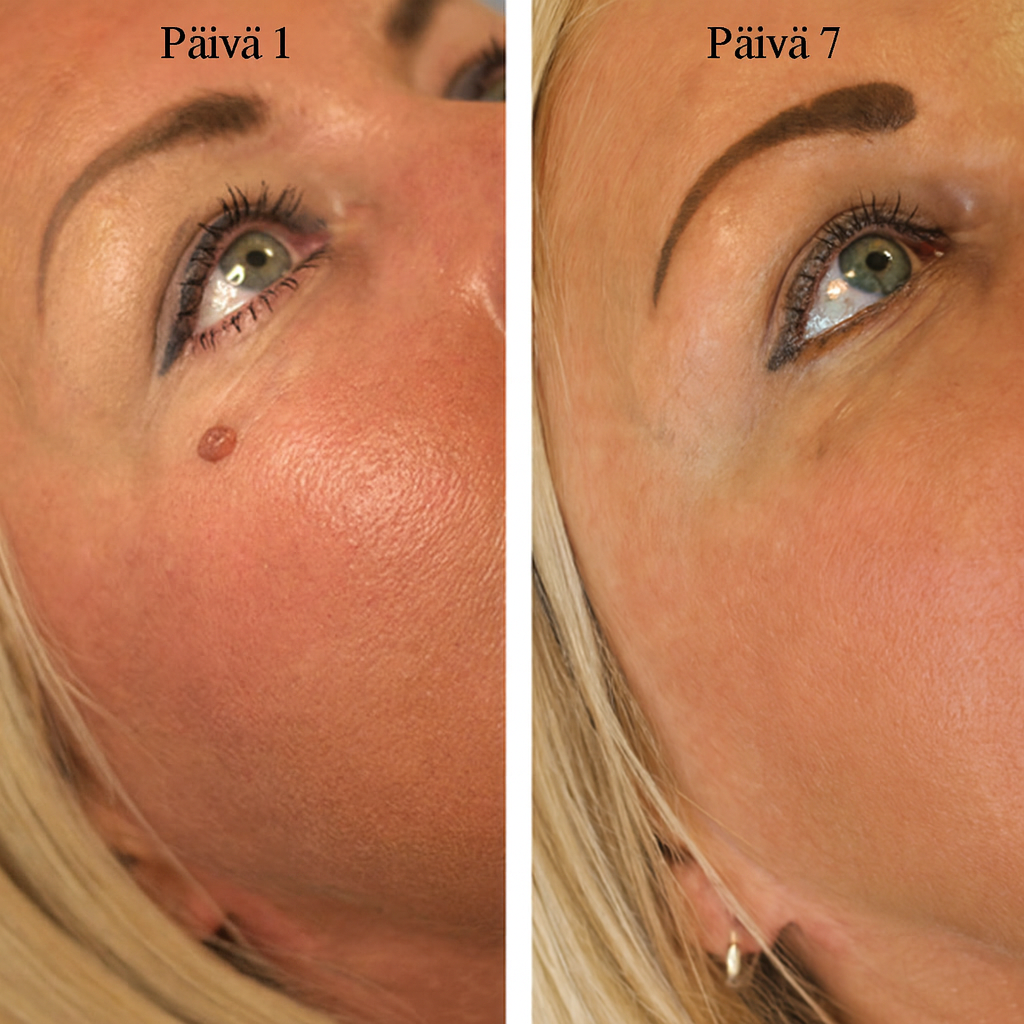 DermaClear Kit™ – Ei enää ihomuutoksia tai syyliä